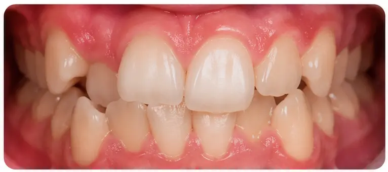 Case 03 — teeth alignment before orthodontic treatment