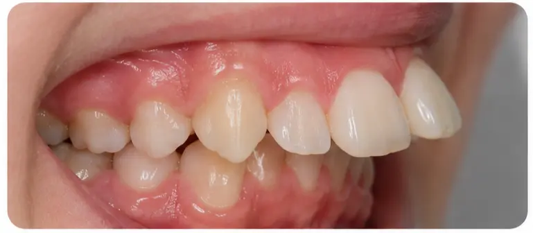 Case 04 — teeth alignment before orthodontic treatment