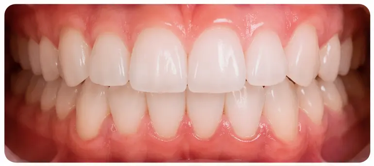 Case 04 — teeth alignment before orthodontic treatment